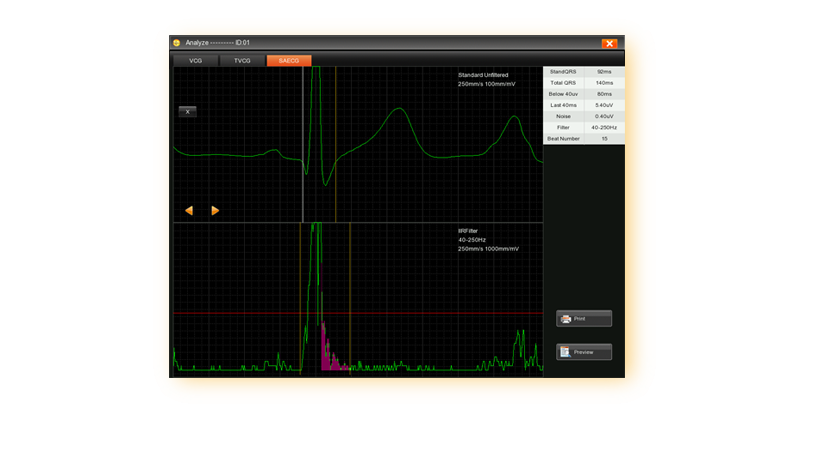 Сигнал-усредненная ЭКГ